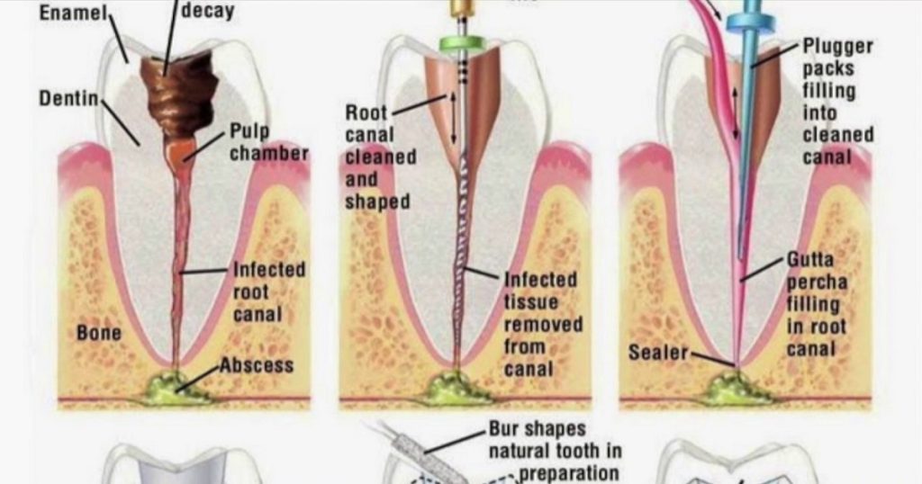 Root Canal Treatment in Lahore