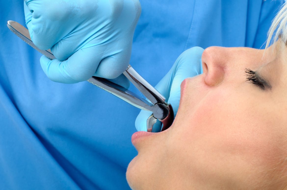 emergency tooth extraction