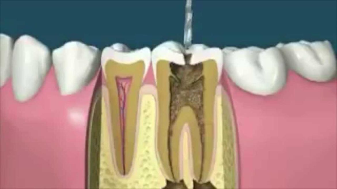 Root Canal Treatment