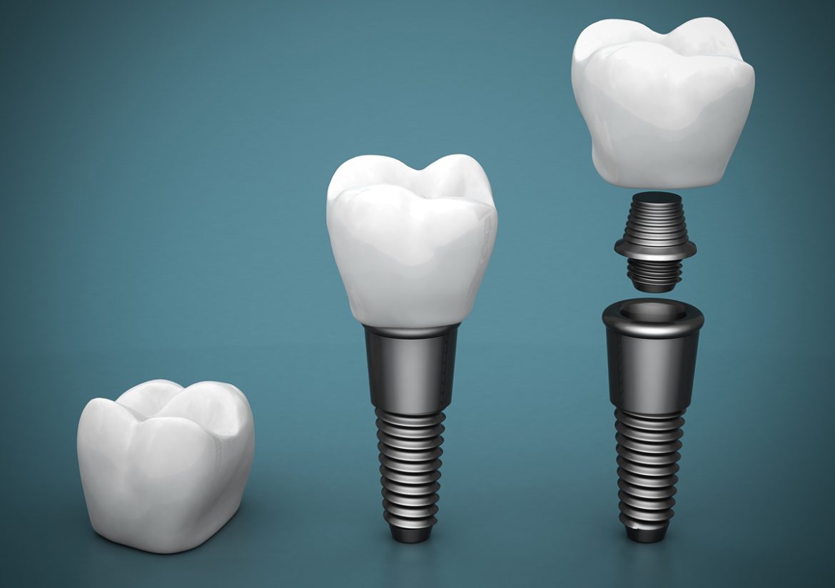 dental implants before and after