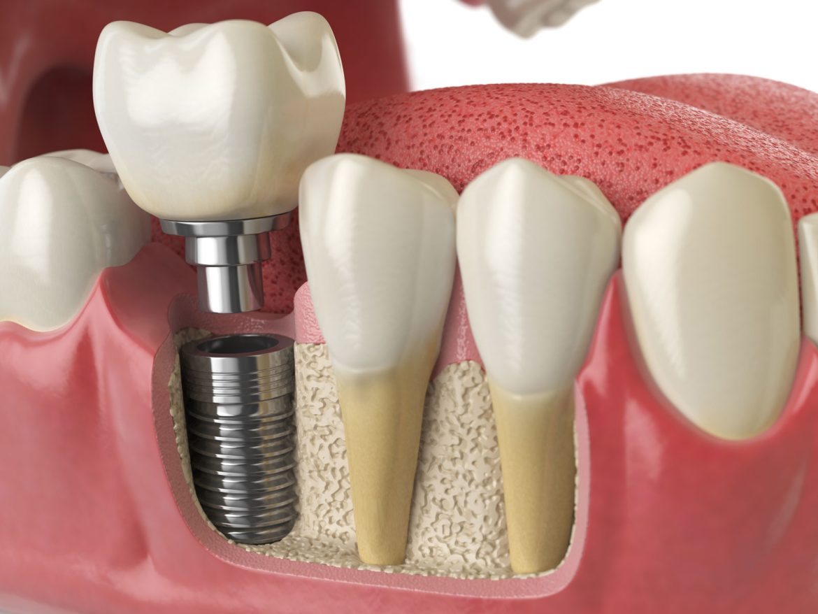 dental implant recovery