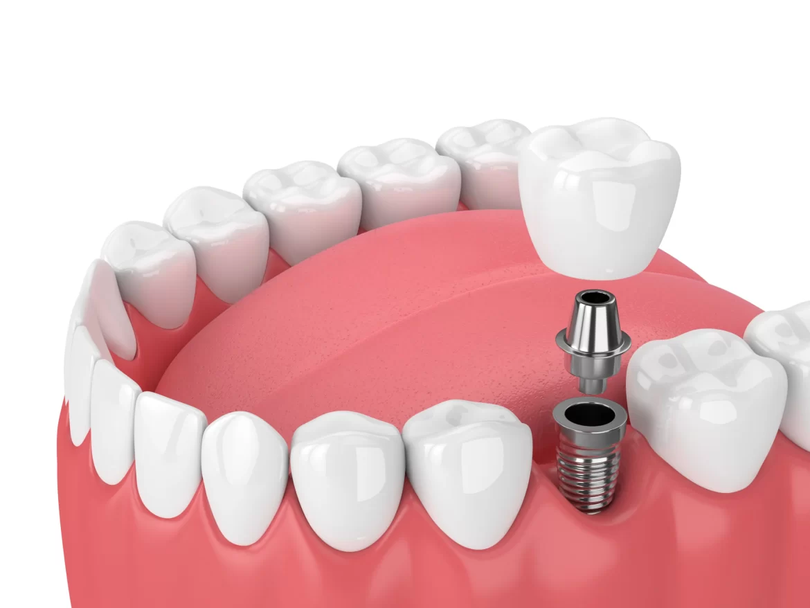 Dental implants cost