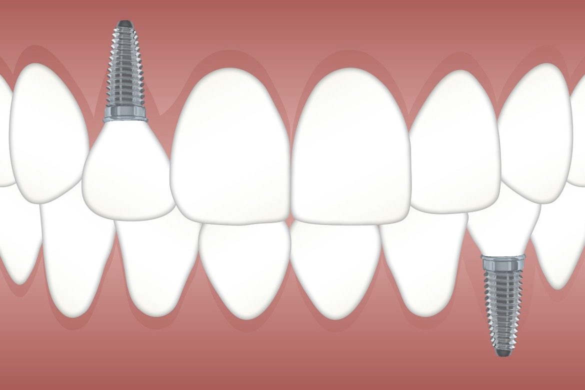 implant dentist houston implant dentist houston