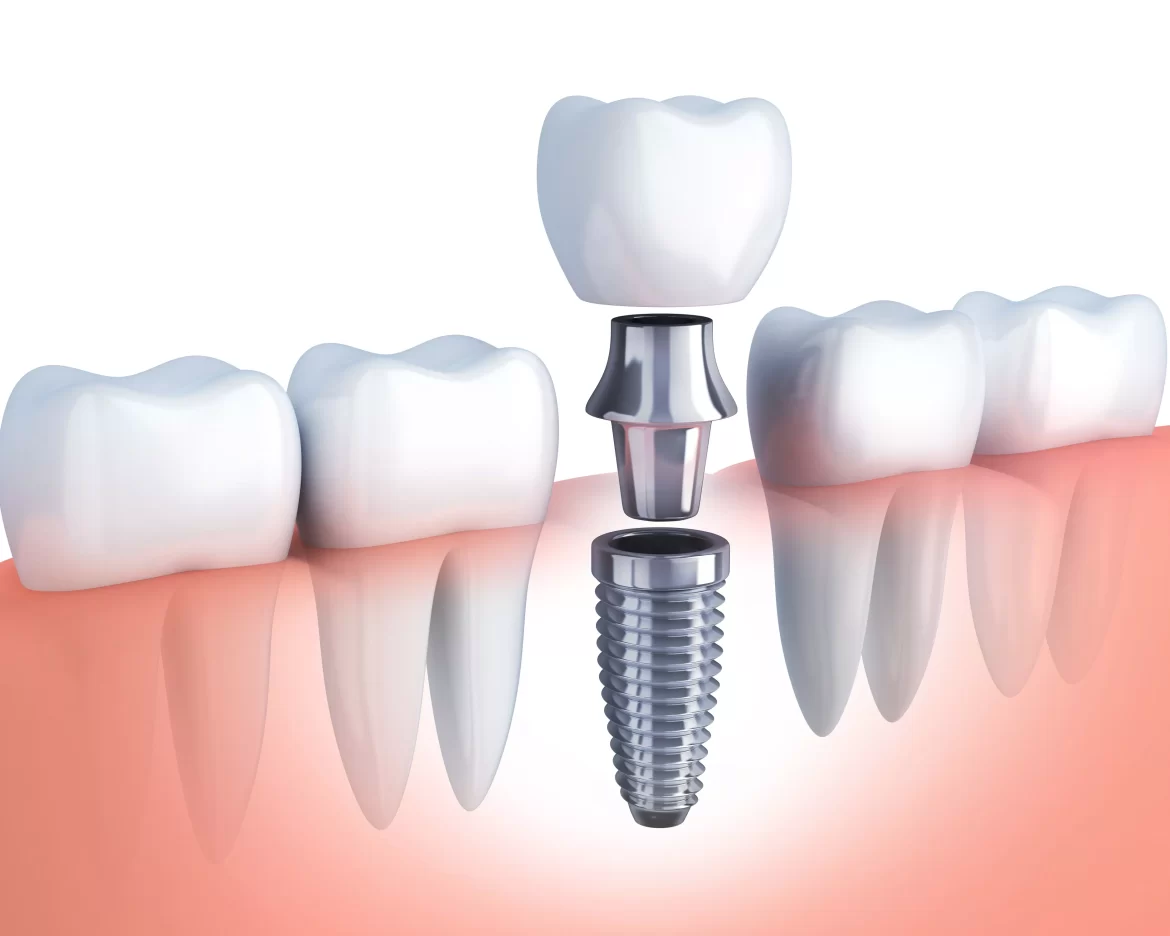 Teeth Replacement Teeth Replacement